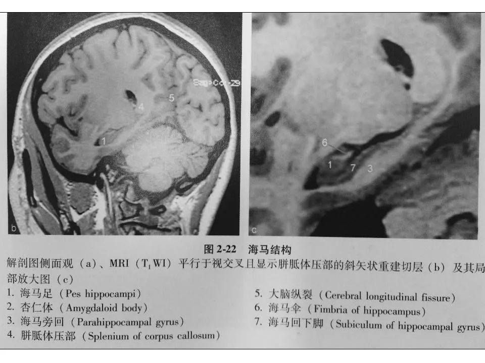 海马解剖结构与mri的诊断应用丨影像天地