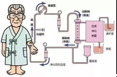 血液透析滤过介绍