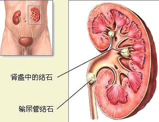 结石碎石后还疼怎么办