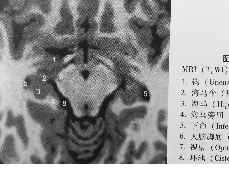 海马解剖结构与mri的诊断应用丨影像天地
