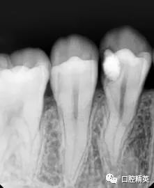 左下后牙急性牙髓炎1例