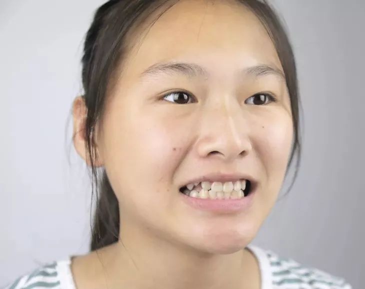 牙齿全被黄渍着了色,让她一张嘴就露出一口大黄牙.
