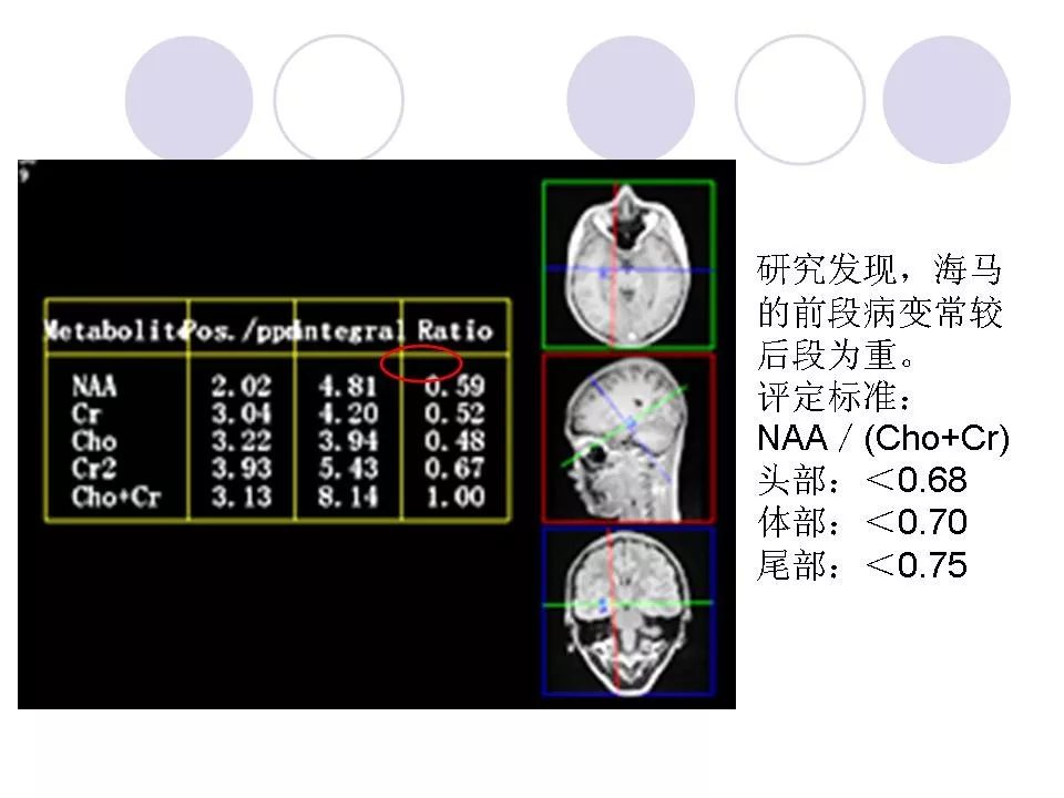 海马解剖结构与mri的诊断应用丨影像天地