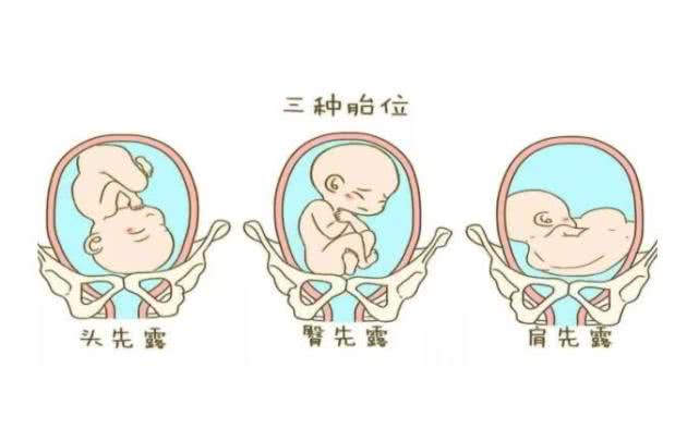 胎位不正又想顺产学会这招体外转胎术2分钟就解决