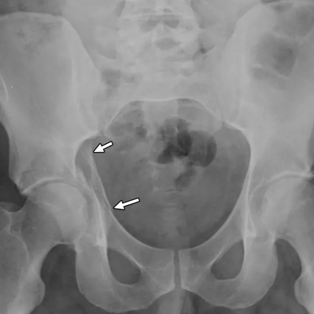 图谱-髋臼骨折影像学分析_髂骨