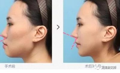 填充鼻小柱基底后,鼻唇角角度增加,下庭看起来更立体.