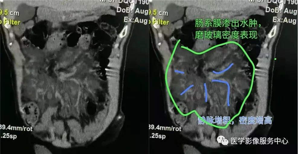 手把手教你 | 平扫ct如何诊断肠系膜静脉血栓