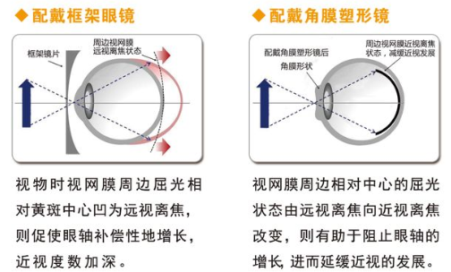 塑形镜的原理_△角膜塑形镜视力矫正原理(3)