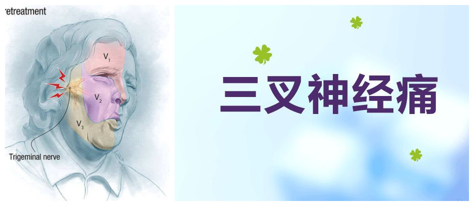 【诊前须知】有规律的脸疼,可能病因是三叉神经痛!