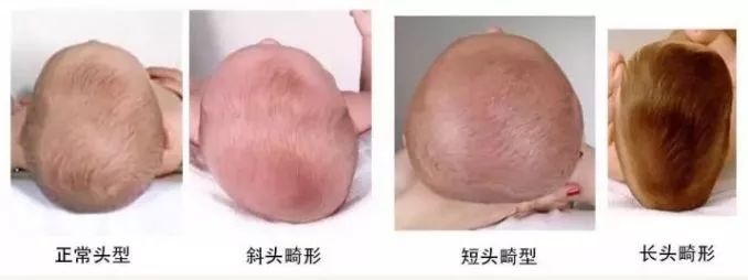                     头型会影响智力发育？孩子睡扁头好还是圆头好？