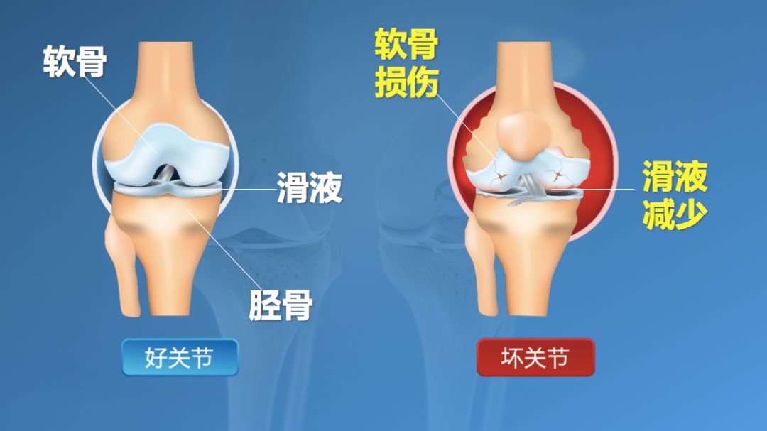 吃钙片到底能不能防治骨关节疾病?这回终于说清楚了