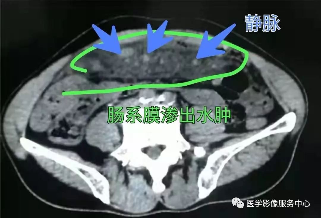 手把手教你平扫ct如何诊断肠系膜静脉血栓