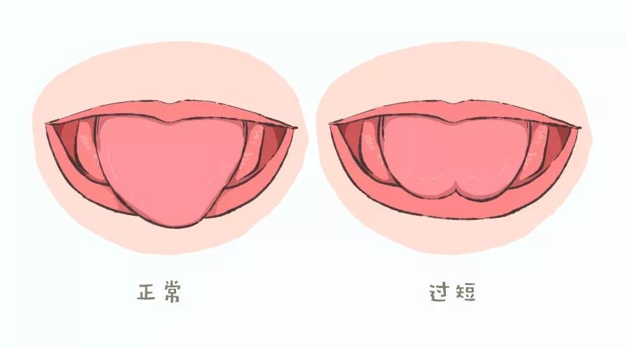 舌系带过短,会限制舌头的正常活动,宝宝可能出现舌头不能舔到上颚或