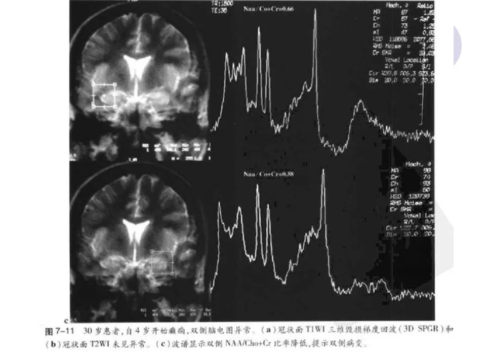 海马解剖结构与mri的诊断应用丨影像天地