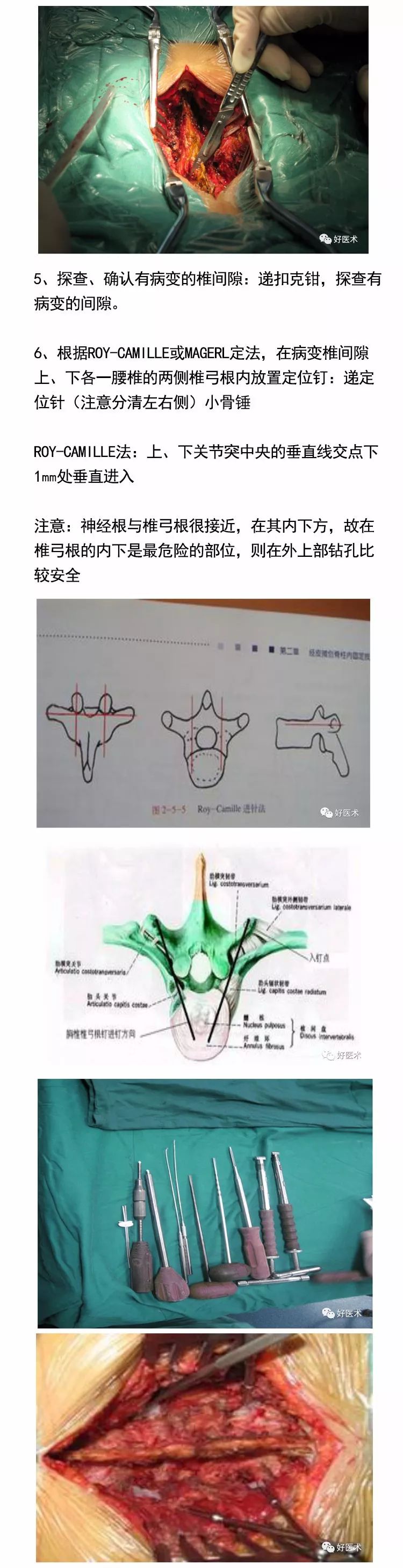 腰椎椎弓根内固定 椎间融合术,手术技巧全解析!