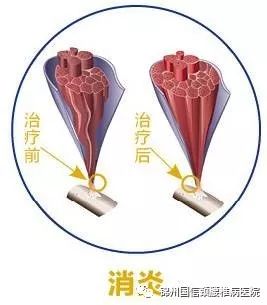 银质针的三大功效你知道吗?