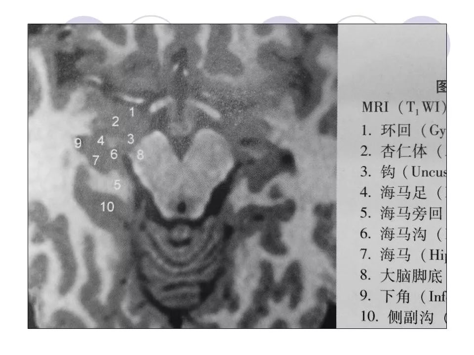 海马解剖结构与mri的诊断应用丨影像天地