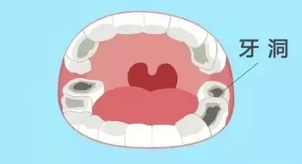 银汞合金补牙材料是如何逐渐退出补牙历史舞台