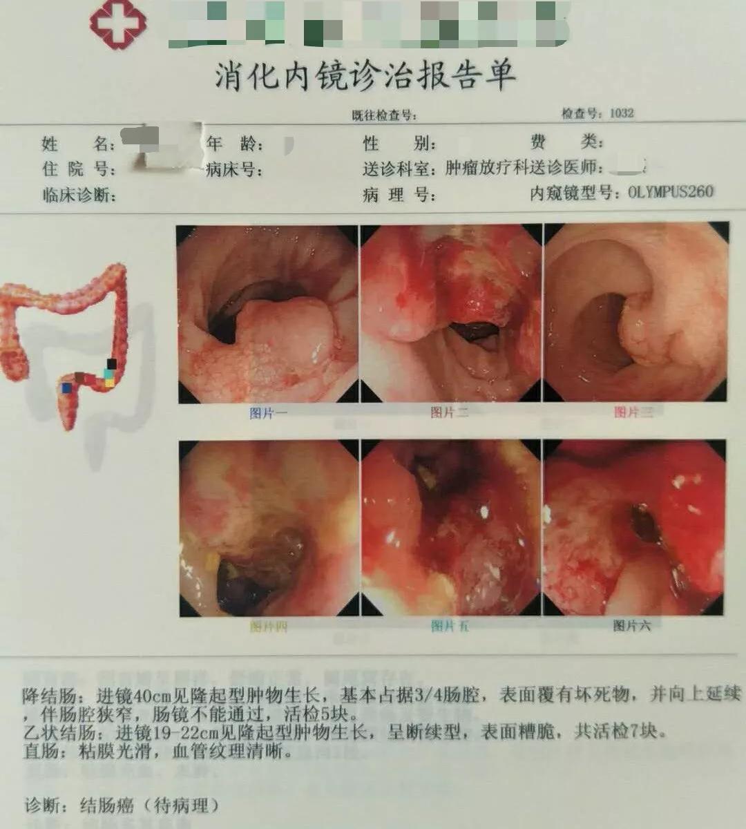 铁路体检检出肠癌,检测便潜血对职业病人群有多重要