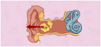 外耳道耵聍栓塞