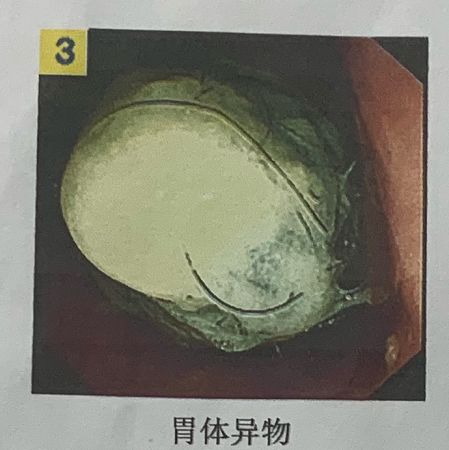                     南宁5岁女孩爱吃头发，致腹痛1年多！医生：异食癖【930新闻眼】