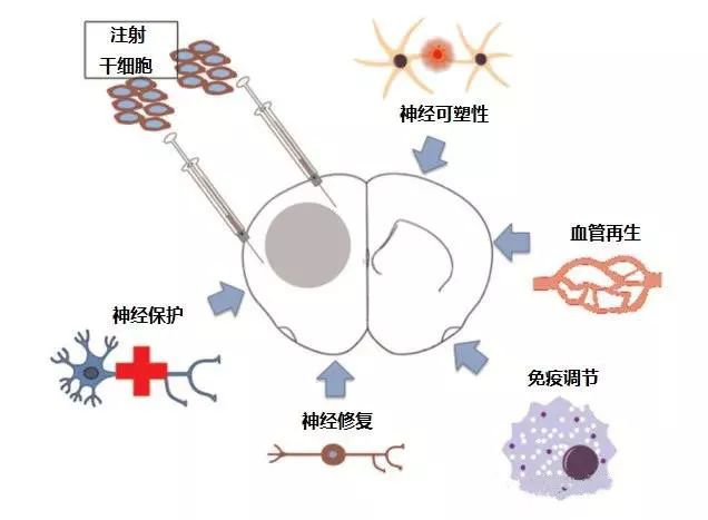 帕金森患者有救了干细胞移植疗法效果感人医学界的又一突破