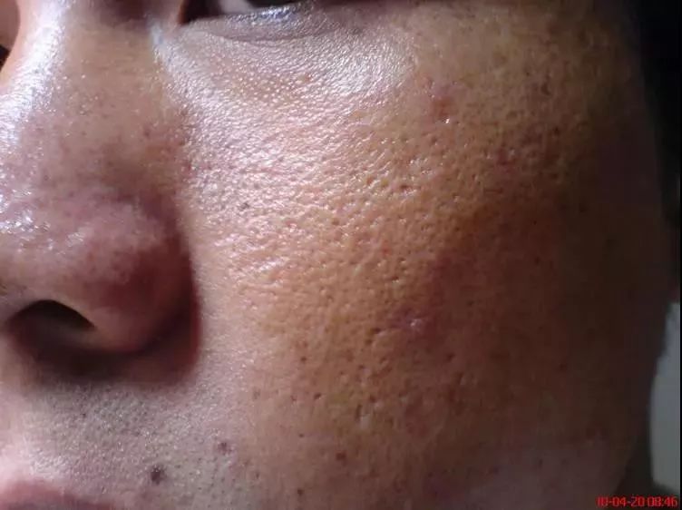 而现在天热,油脂分泌旺盛后, 清洁,去黑头的工作一定要重视起来.