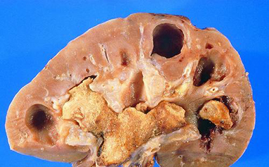 肾结石一般多久才会被发现 601df5be054f4459a5aabb07e6590925.jpeg