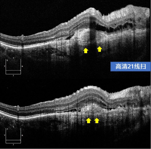 分层:orcc广角octa(14x14mm)右眼视盘颞上方见脉络膜骨瘤瘤体