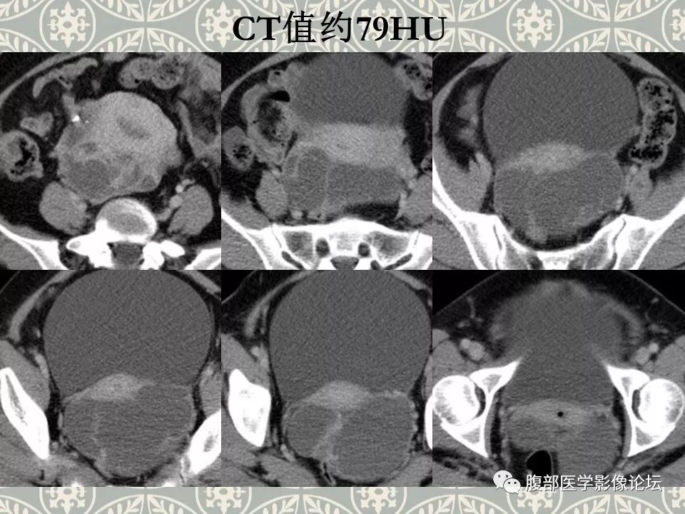 (左侧阔韧带)平滑肌瘤