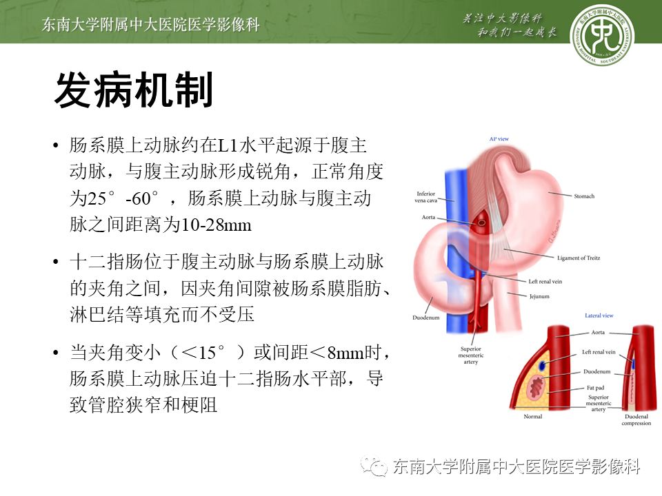 推荐| 肠系膜上动脉压迫综合征影像表现