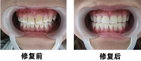 【氟斑牙】氟斑牙的形成_氟斑牙怎么去除