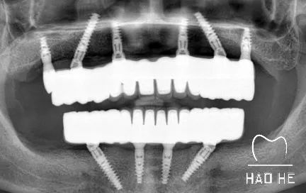 无牙颌种植氧化锆桥架修复体一例