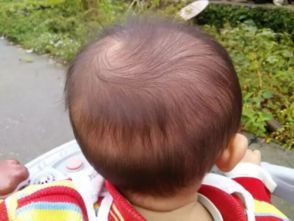                     南宁5岁女孩爱吃头发，致腹痛1年多！医生：异食癖【930新闻眼】