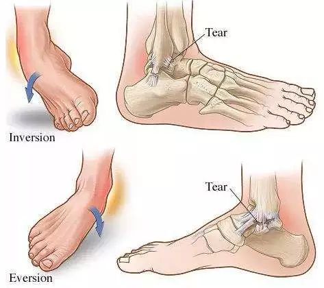 安全 无痛 踝关节急性损伤的正确打开方式
