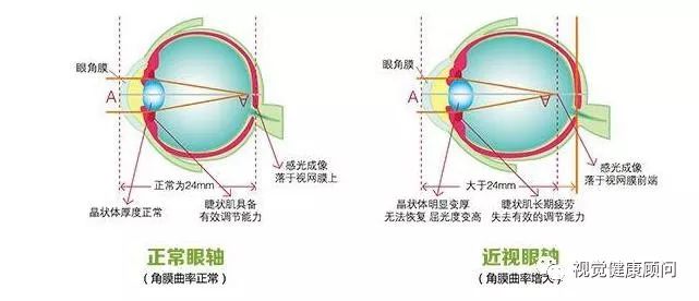 眼角膜是怎么长的 d650fa400acd41abad537b6994546130.jpeg