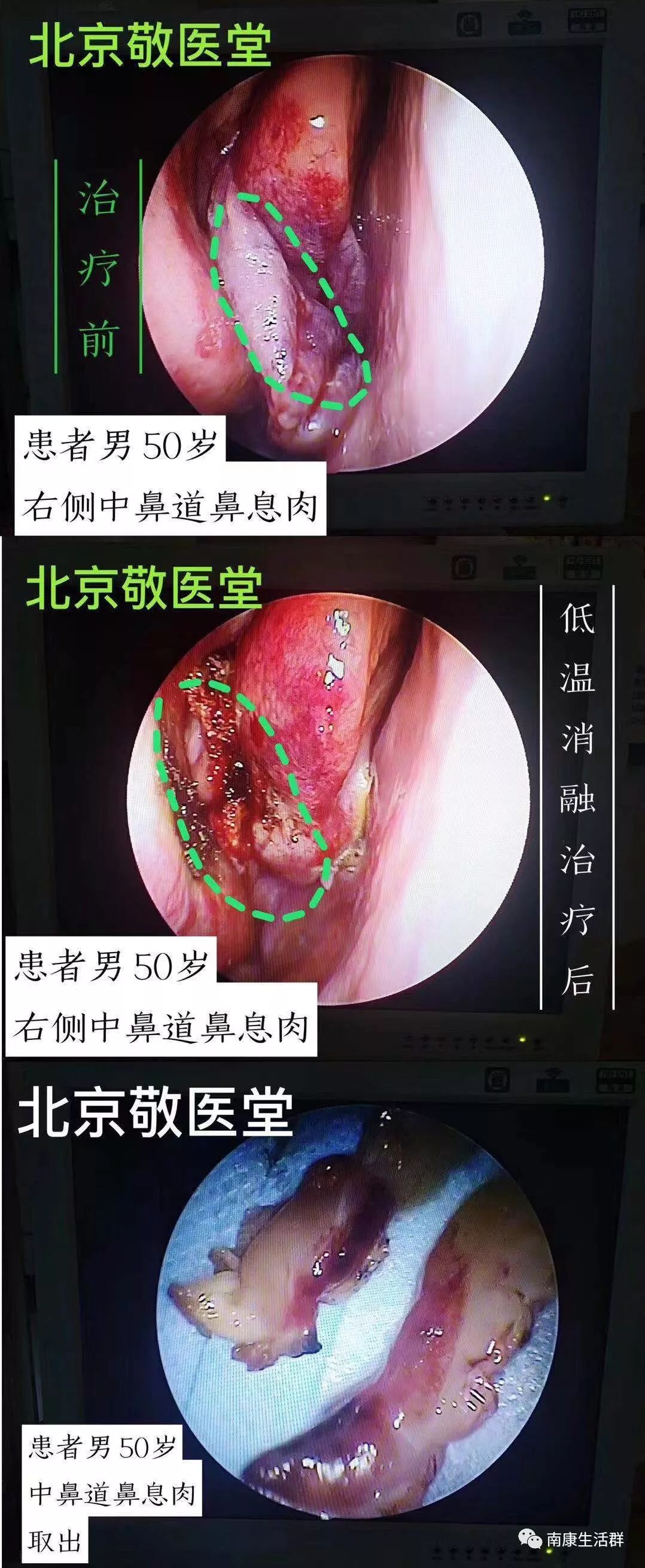 鼻窦炎,过敏性鼻炎,鼻息肉,慢性咽炎,扁桃体炎利用高清鼻内窥镜结合