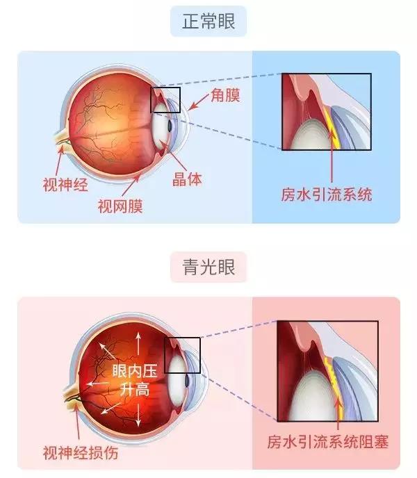 配镜矫正视力什么原理_散光是什么配镜原理(3)