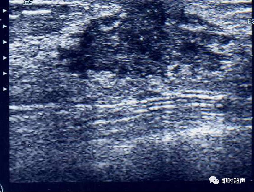 乳腺非肿瘤性疾病的超声诊断