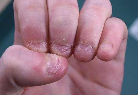 二,孩子习惯啃咬手指甲有什么危害?
