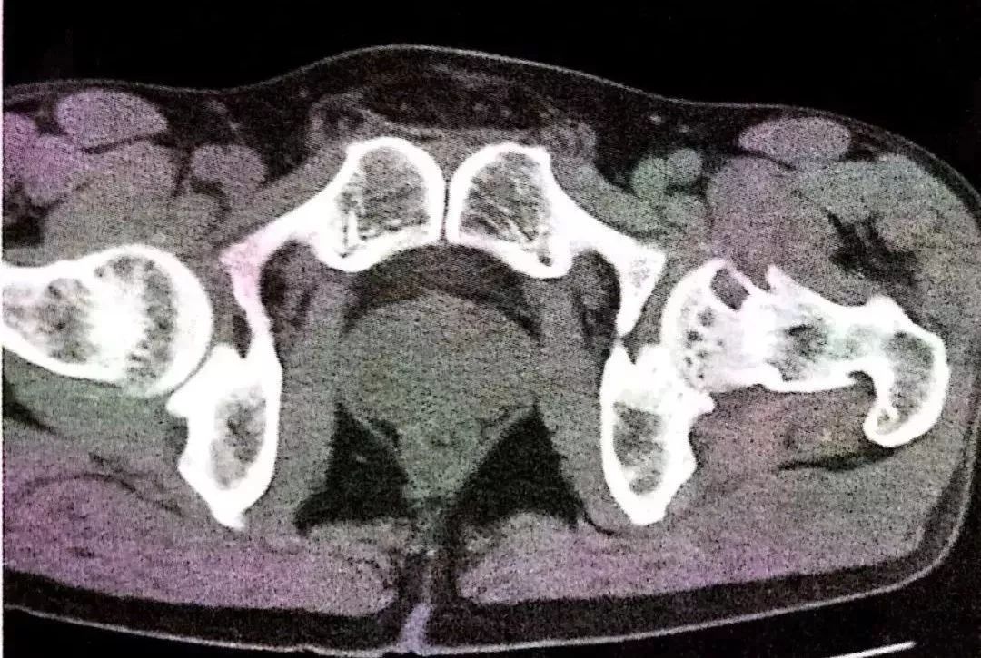 髋骨关节炎的临床表现及治疗方法