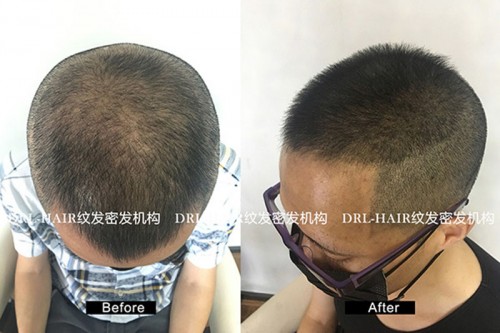 可生发际线是什么原理_你有什么可豪横的图片(2)