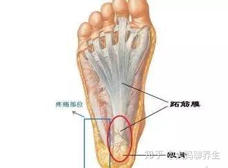 跟骨后滑囊炎其实就是滑囊的炎症,人体的足跟部总共存在三个滑囊,而