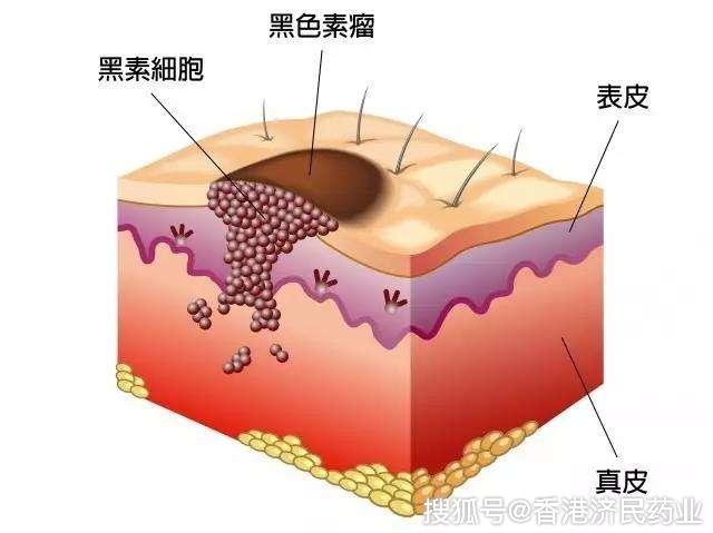 黑色素瘤的三大早期症状