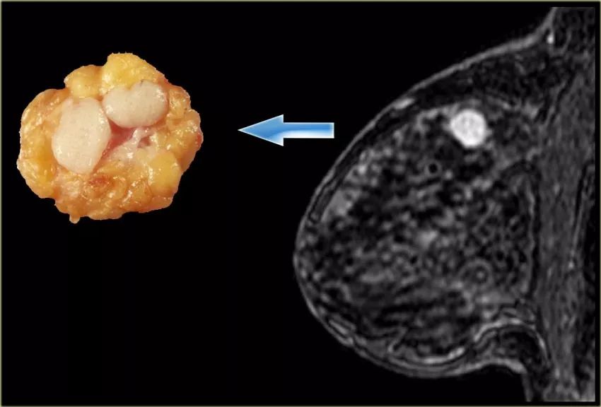 看下图乳腺纤维瘤是1种良性肿瘤,并不是癌症,所以即使有也不要有思想