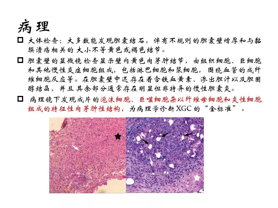 黄色肉芽肿性胆囊炎