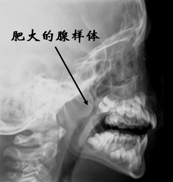 怀疑腺样体肥大,要做什么检查?