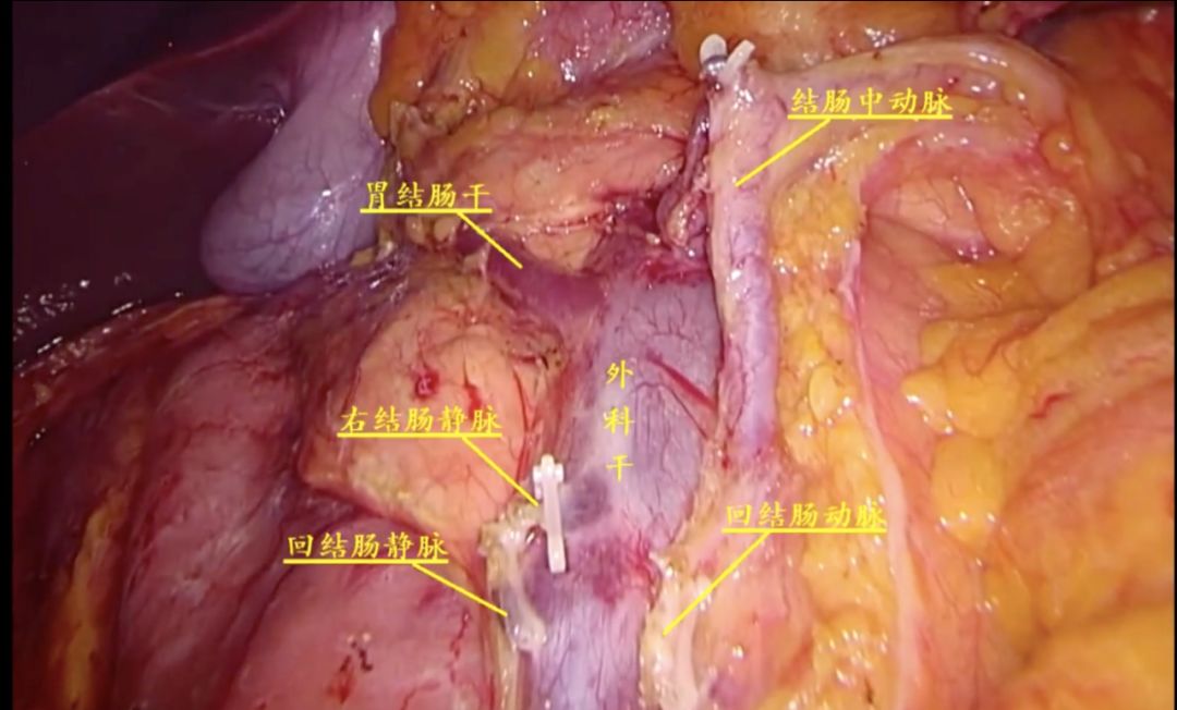 一干: 外科干 二净(静) 回结肠静脉 中结肠静脉 三根叉: 胃结干分支