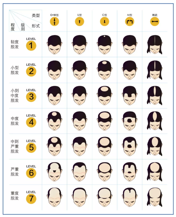 跟我照着这张脱发等级图对比.