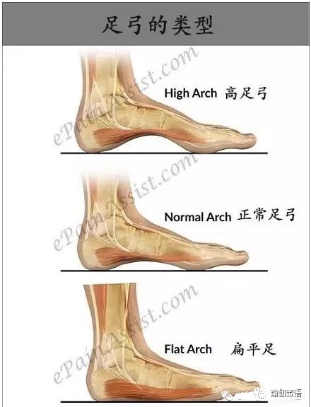 拇指外翻,扁平足,足底筋膜炎.